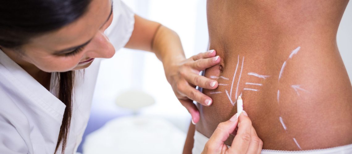 Close-up of surgeon drawing lines on womans abdomen for liposuction and cellulite removal